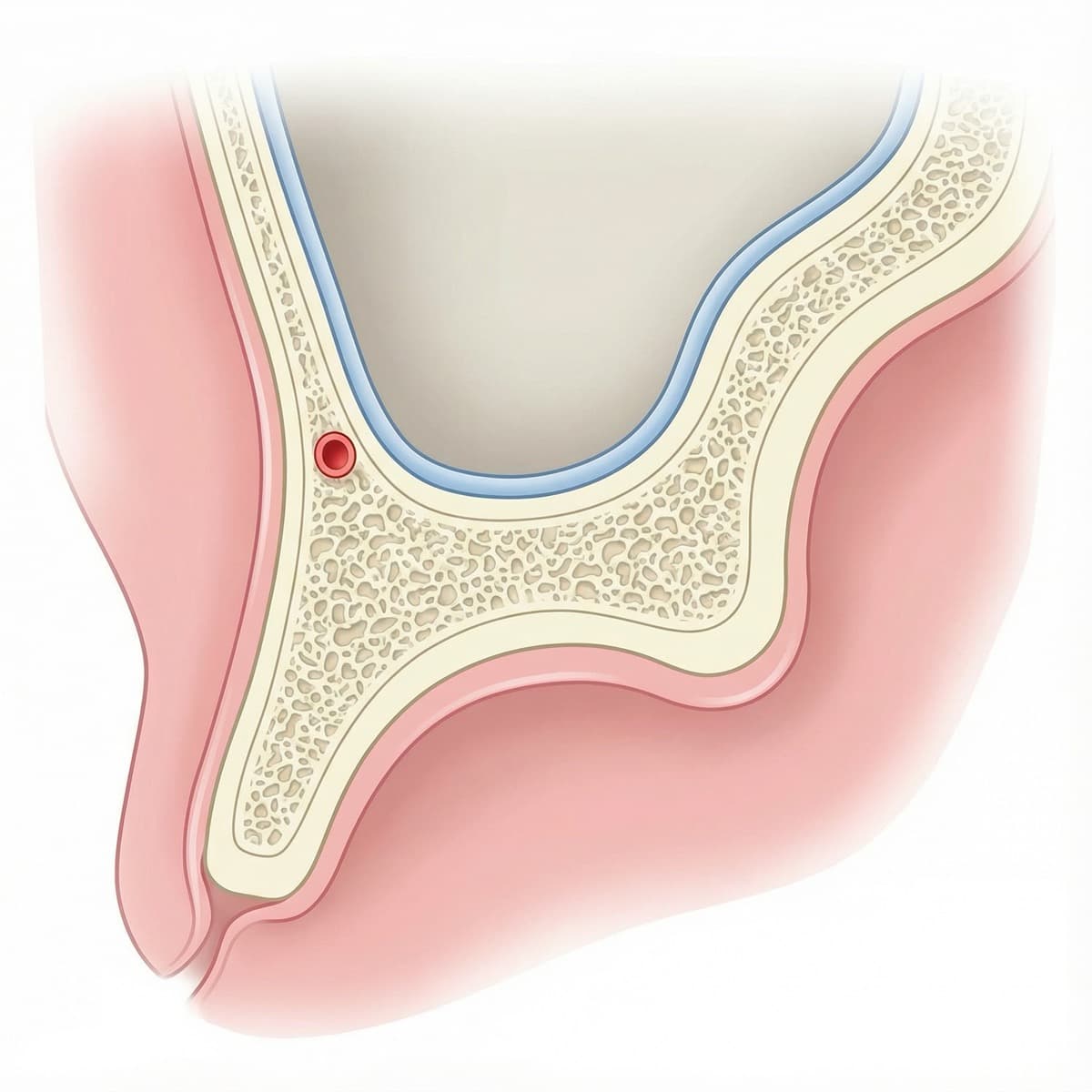 Sinus lift anatomy diagram showing maxillary sinus and Schneiderian membrane